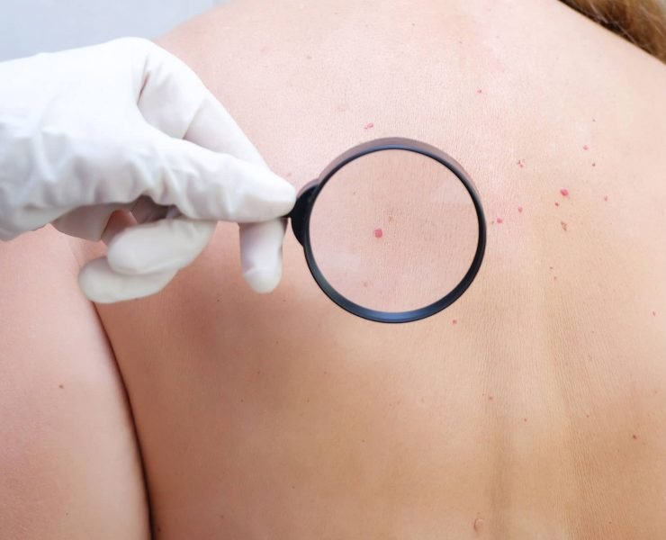 Cherry Angiomas Treatment