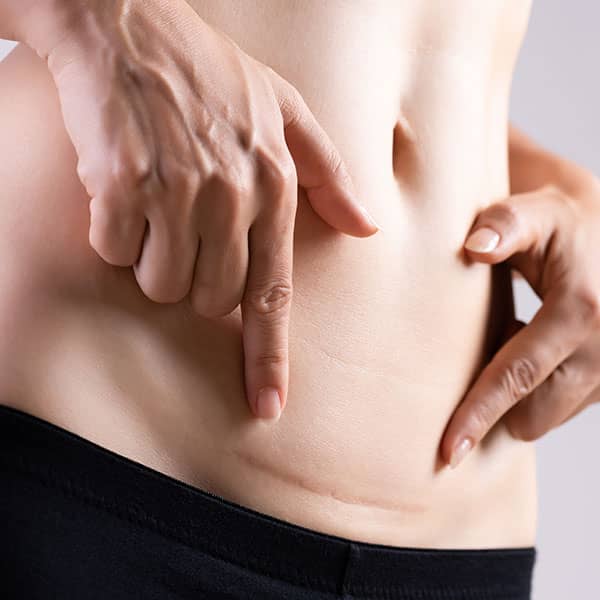 laser scar removal treatments