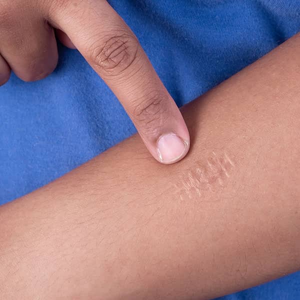 laser scar removal treatments