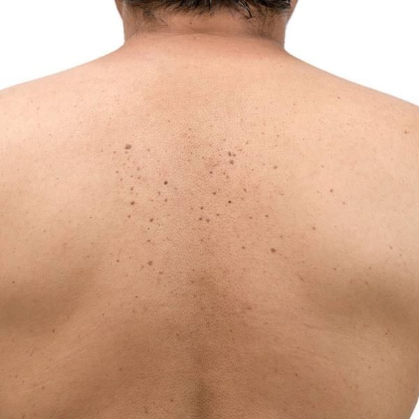 skin tags removal seborrheic keratosis back