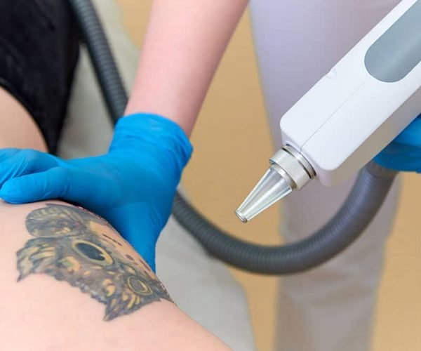 Cynosure PicoSure laser tattoo removal