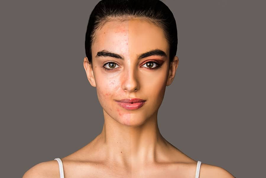 Laser Acne Treatment Milwaukee