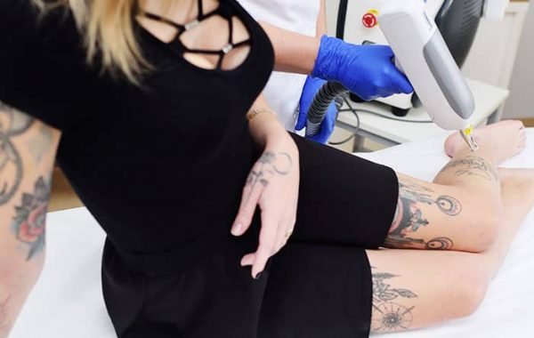 PicoSure laser tattoo removal Milwaukee Wi