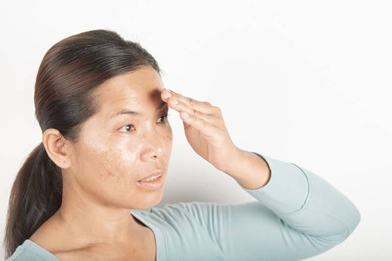 dark skin spots