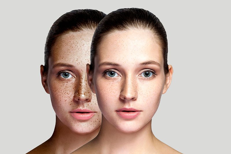 laser treatment dark spots removing