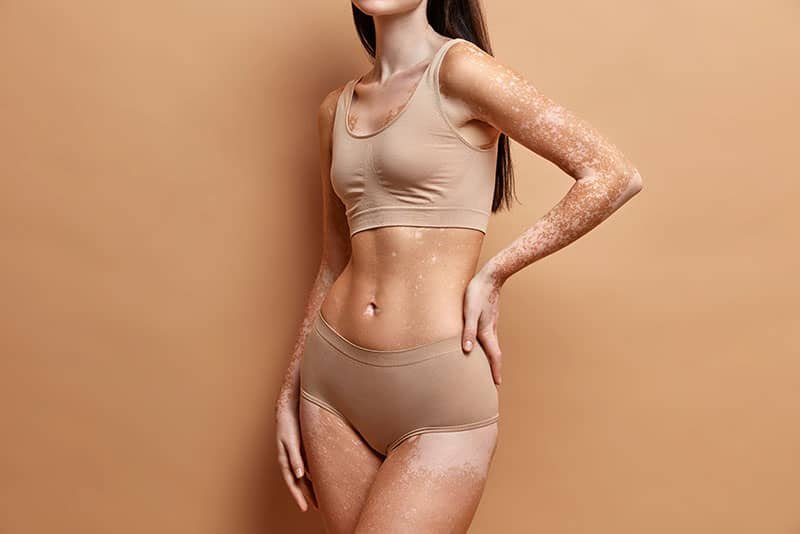 skin pigmentation
