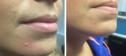 before after photo mole removal Milwaukee before after photo mole removal Milwaukee