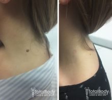 before after photo skin tag removal Мilwaukee