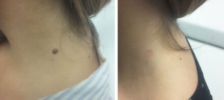 before after photo skin tag removal Мilwaukee before after photo skin tag removal Мilwaukee