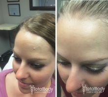 before after photo skin tag Brookfield