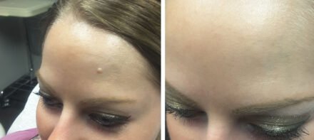before after photo skin tag Brookfield before after photo skin tag Brookfield