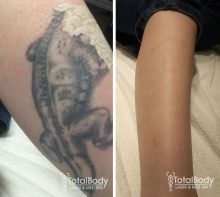 before after photos laser tattoo removal