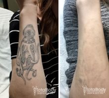 black white tattoo laser removal before-after-Milwaukee