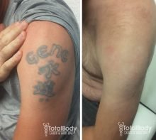 colorful tattoo laser removal before after Milwaukee