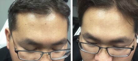 skin tag before after photo Milwaukee skin tag before after photo Milwaukee