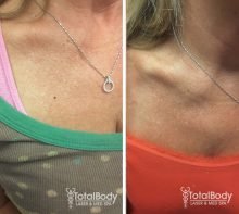 skin tag removal procedure before after photo