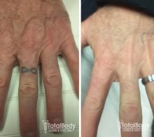 before after tattoo removal ring fingers